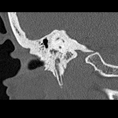 File:Adhesive chronic otitis media (Radiopaedia 14270-14148 Coronal bone window - right 16).jpg