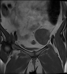 File:Adnexal multilocular cyst (O-RADS US 3- O-RADS MRI 3) (Radiopaedia 87426-103754 Coronal 10).jpg
