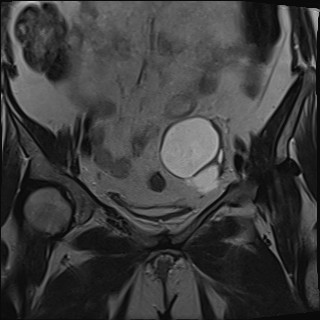 File:Adnexal multilocular cyst (O-RADS US 3- O-RADS MRI 3) (Radiopaedia 87426-103754 Coronal T2 12).jpg