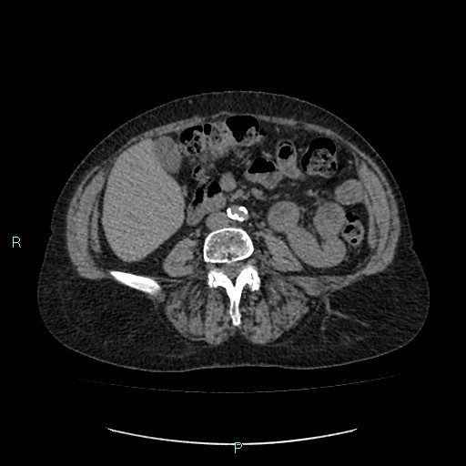 File:Adrenal collision tumor (ACT) (Radiopaedia 48462-53379 Axial non-contrast 33).jpg
