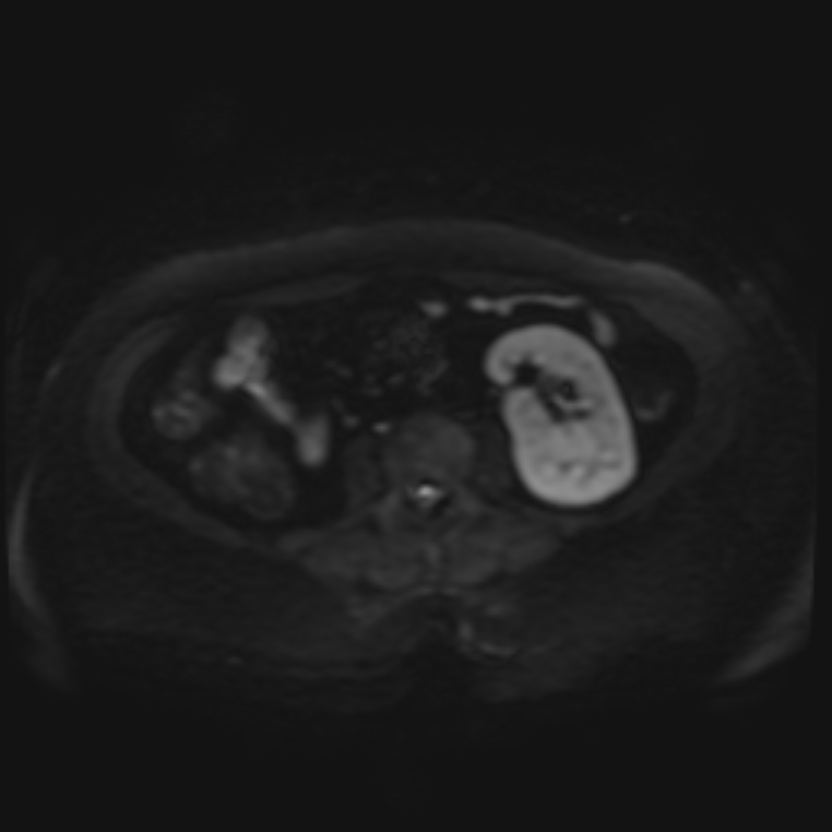 Adrenal cortical carcinoma (Radiopaedia 70906-81116 Axial DWI 22).jpg