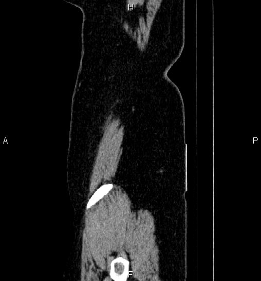 Adrenal cortical carcinoma (Radiopaedia 84882-100379 Sagittal C+ portal venous phase 87).jpg