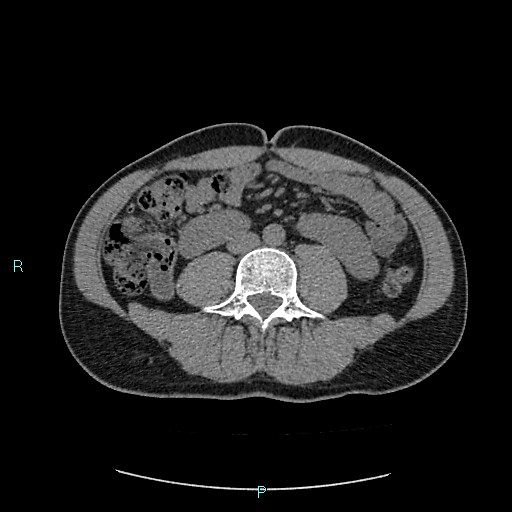 Adrenal cystic lymphangioma (Radiopaedia 83161-97534 Axial non-contrast 55).jpg