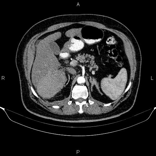Adrenal hemorrhage (Radiopaedia 62622-70916 Axial C+ arterial phase 120).jpg