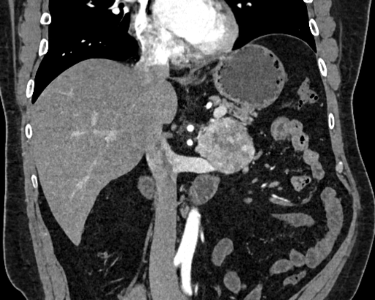 File:Adrenal metastases (Radiopaedia 73082-83791 Coronal C+ arterial phase 16).jpg