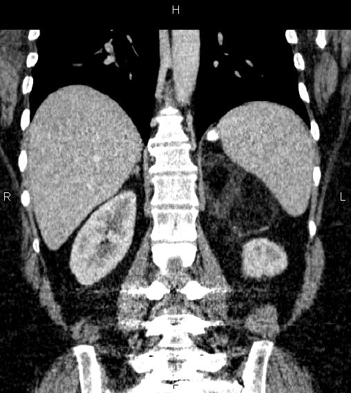 Adrenal myelolipoma (Radiopaedia 84319-99617 Coronal renal cortical phase 55).jpg