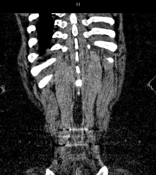 Adrenal myelolipoma (Radiopaedia 84319-99617 Coronal renal cortical phase 73).jpg