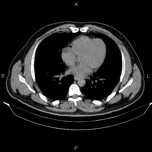 Adrenal myelolipoma (Radiopaedia 84321-99619 Axial non-contrast 4).jpg
