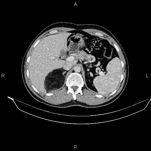 Adrenal myelolipoma (Radiopaedia 87794-104246 Axial renal cortical phase 28).jpg