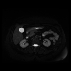 File:Adrenal myelolipoma - MRI (Radiopaedia 83249-97646 Axial STIR 20).jpg