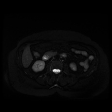 File:Adrenal myelolipoma - MRI (Radiopaedia 83249-97646 Axial STIR 24).jpg