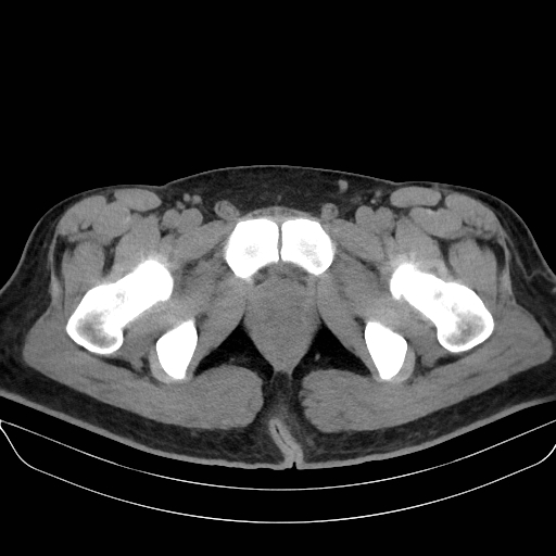 Adrenal myelolipoma - bilateral (Radiopaedia 74805-85810 Axial non-contrast 85).jpg