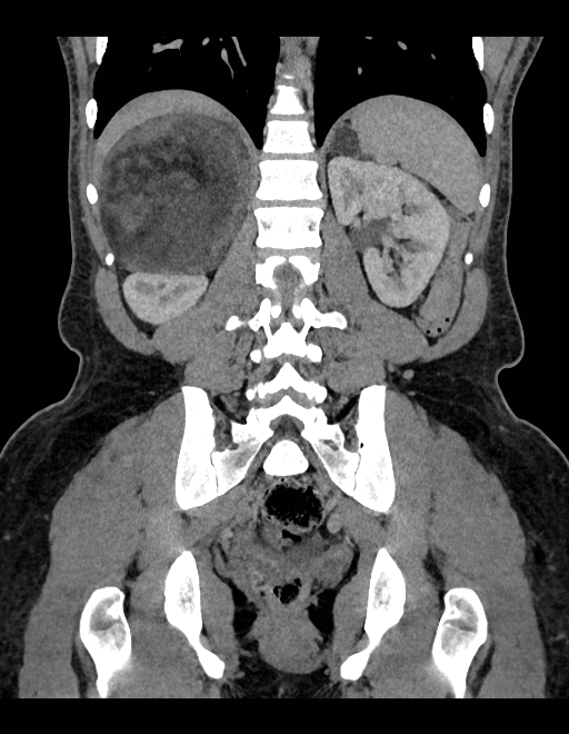 Adrenal myelolipoma - bilateral (Radiopaedia 74805-85810 Coronal C+ portal venous phase 109).jpg