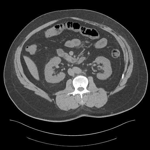 File:Adrenal vein sampling and adrenal nodular hyperplasia - Conn syndrome (Radiopaedia 30561-31337 Axial non-contrast 41).jpg