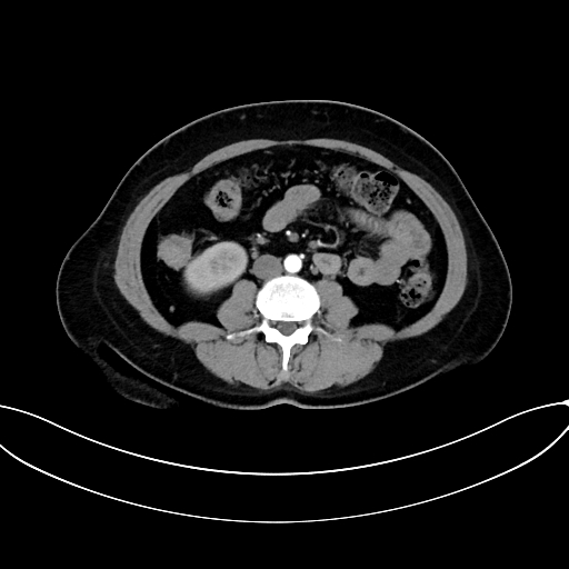 Adrenocortical carcinoma (Radiopaedia 87281-103569 Axial C+ arterial phase 48).jpg