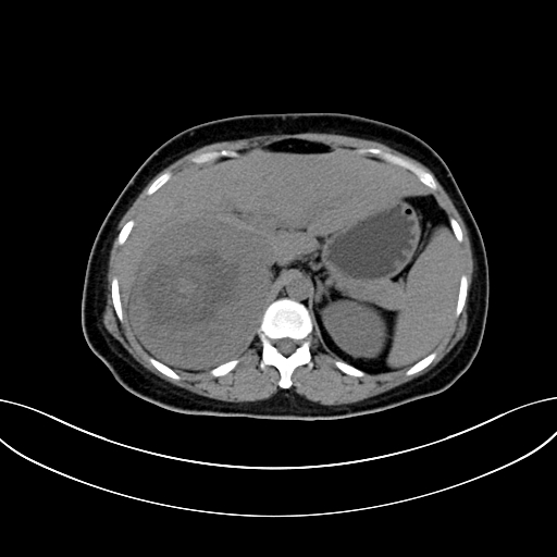 Adrenocortical carcinoma (Radiopaedia 87281-103569 Axial non-contrast 26).jpg