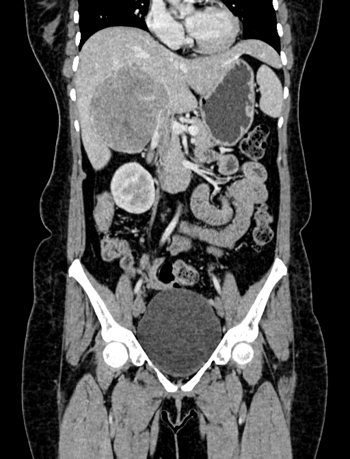 Adrenocortical carcinoma (Radiopaedia 87281-103569 Coronal C+ portal venous phase 30).jpg