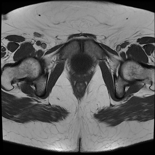 File:Adult granulosa cell tumor of the ovary (Radiopaedia 64991-73953 Axial T1 21).jpg