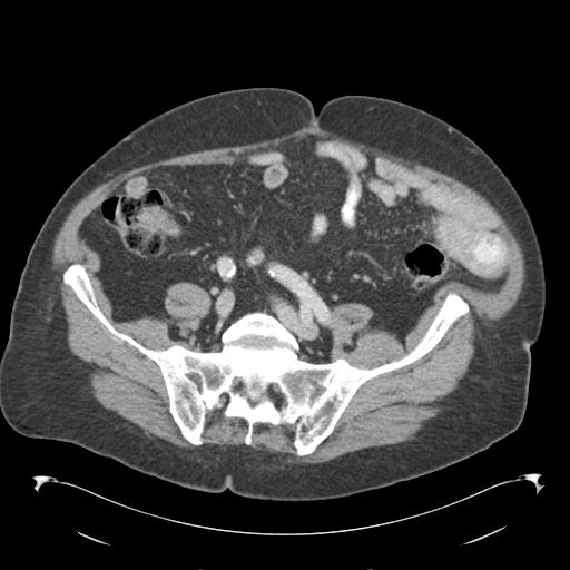 Adult ileal intussusception with secondary obstruction (Radiopaedia 30395-31051 Axial C+ portal venous phase 56).jpg