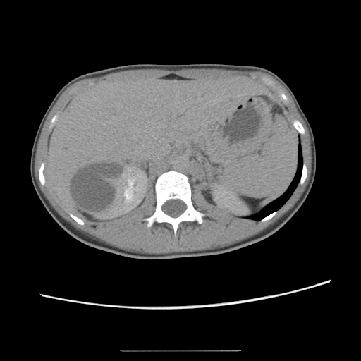 Adult polycystic kidney disease (Radiopaedia 48845-53876 Axial renal excretory phase 29).jpg
