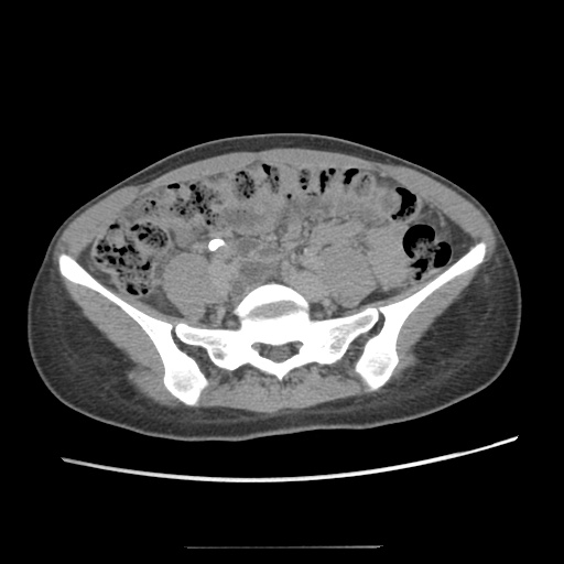 Adult polycystic kidney disease (Radiopaedia 48845-53876 Axial renal excretory phase 65).jpg