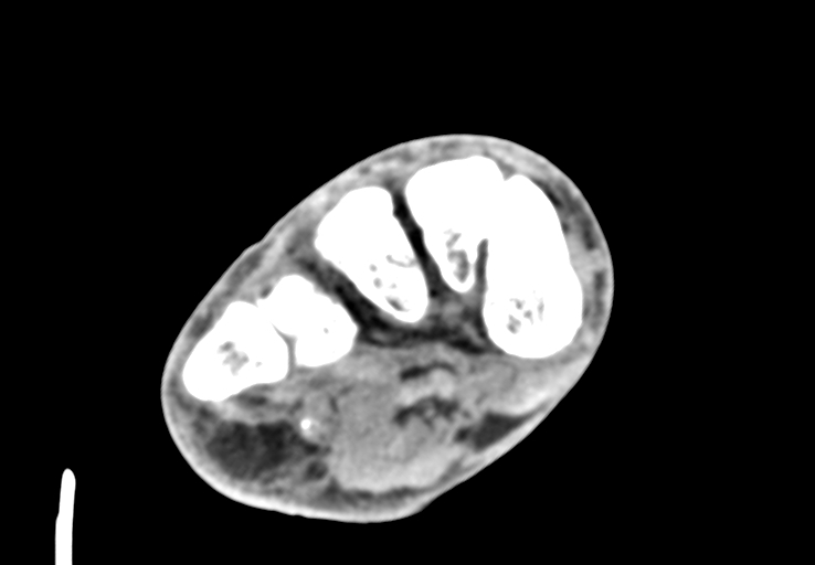Advanced osteomyelitis due to open metatarsal fracture (Radiopaedia 83891-99095 Axial non-contrast 24).jpg