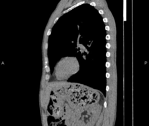 Air bronchogram in pneumonia (Radiopaedia 85719-101512 F 67).jpg