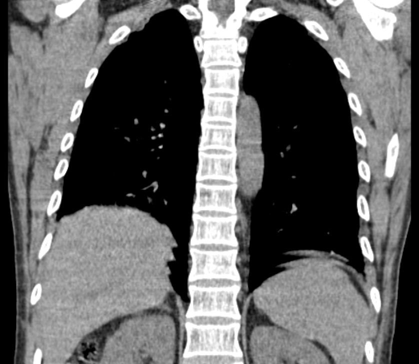 Airway foreign body in adult (Radiopaedia 85907-101779 Coronal liver window 195).jpg
