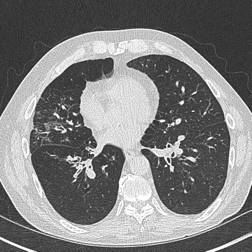 Allergic bronchopulmonary aspergillosis (Radiopaedia 44760-48571 Axial lung window 40).png