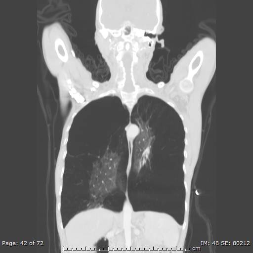 Alpha-1-antitrypsin deficiency (Radiopaedia 50561-55987 Coronal lung window 40).jpg