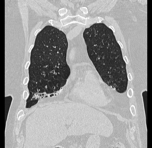 Alpha-1-antitrypsin deficiency (Radiopaedia 72058-82557 Coronal lung window 10).jpg