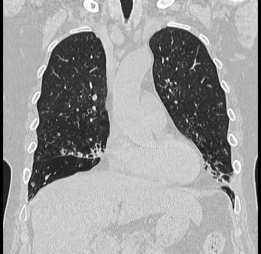 Alpha-1-antitrypsin deficiency (Radiopaedia 72058-82557 Coronal lung window 22).jpg