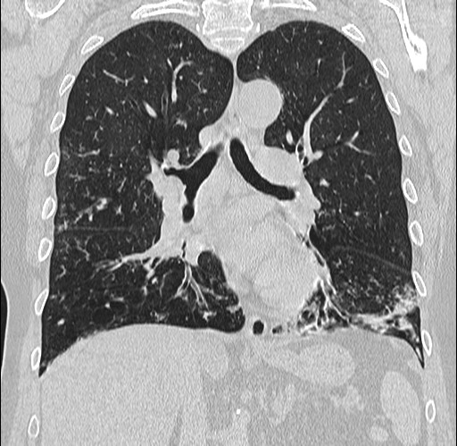 Alpha-1-antitrypsin deficiency (Radiopaedia 72058-82557 Coronal lung window 46).jpg