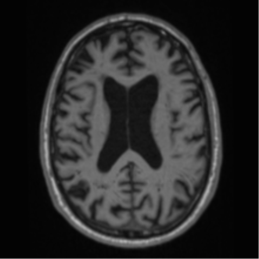 Alzheimer's disease- with Gerstmann syndrome and dressing apraxia (Radiopaedia 54882-61150 Axial T1 46).png