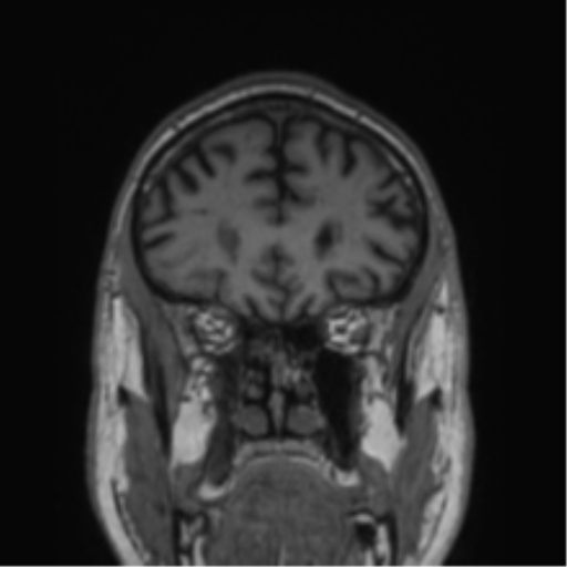 Alzheimer's disease- with Gerstmann syndrome and dressing apraxia (Radiopaedia 54882-61150 Coronal T1 69).png