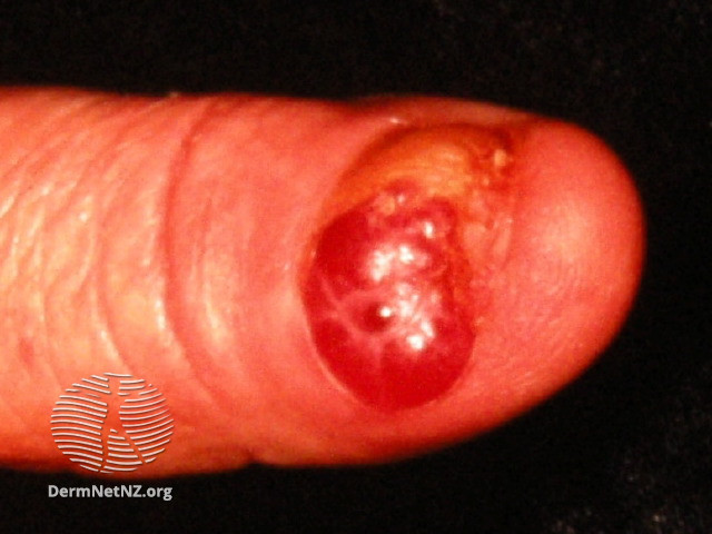 File:Amelanotic melanoma (DermNet NZ amelanotic-melanoma-014).jpg