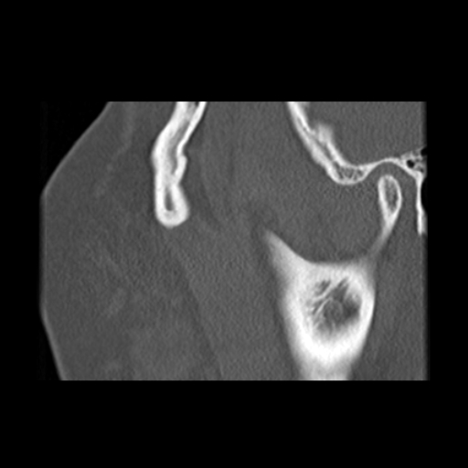 File:Ameloblastic fibro-odontoma (Radiopaedia 18843-18780 bone window 17).jpg