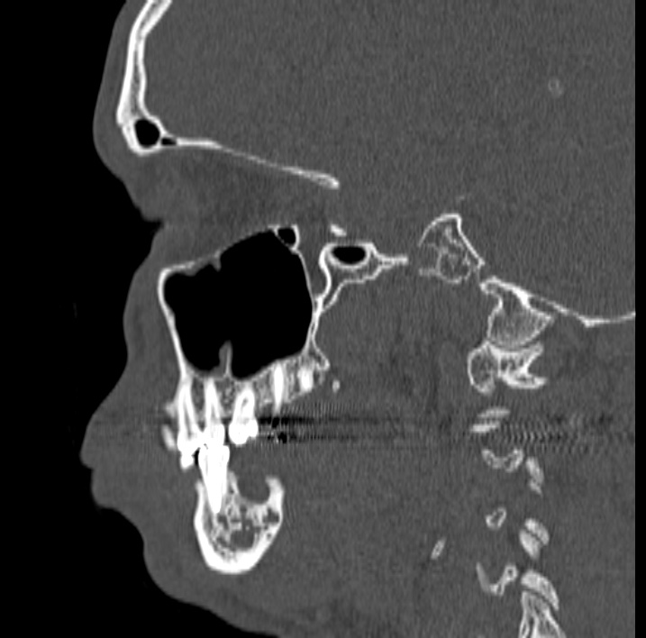 Ameloblastoma (Radiopaedia 77750-89997 Sagittal bone window 29).jpg