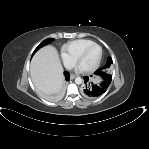File:Amoebic liver abscess (Radiopaedia 52611-58530 A 10).png