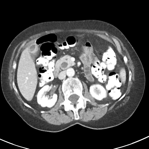 Ampullary adenocarcinoma (Radiopaedia 34013-35237 C 19).png