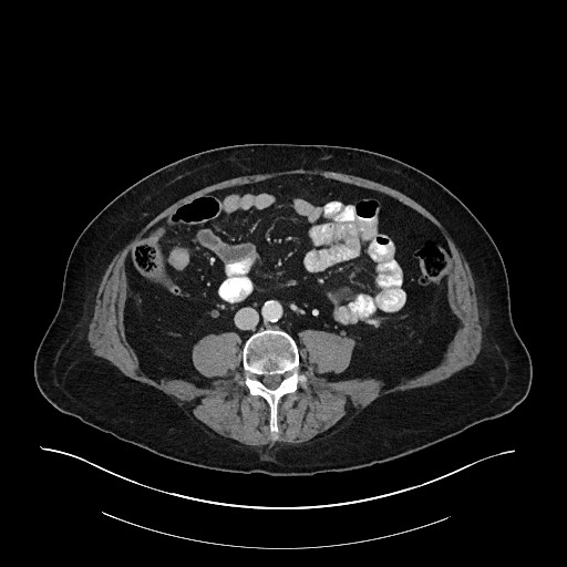 File:Ampullary adenocarcinoma (Radiopaedia 59373-66734 Axial 196).jpg