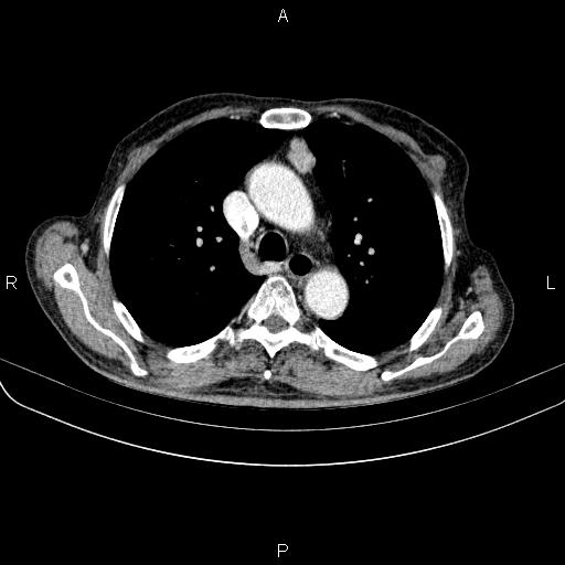 File:Ampullary adenocarcinoma (Radiopaedia 86093-102033 B 26).jpg