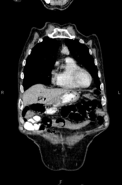 Ampullary adenocarcinoma (Radiopaedia 86093-102033 D 11).jpg