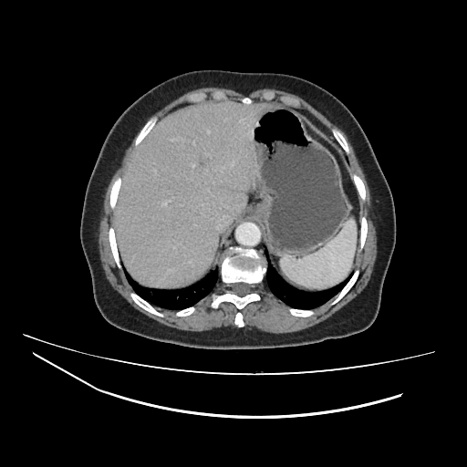 Ampullary tumor (Radiopaedia 60333-67998 A 10).jpg