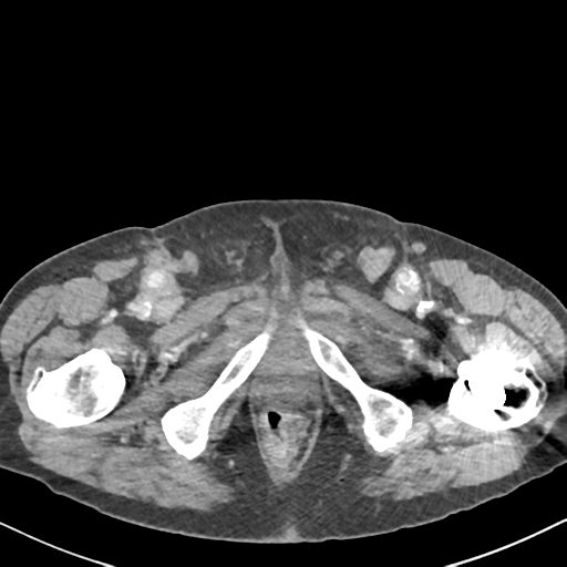 File:Amyand hernia (Radiopaedia 39300-41547 A 78).png