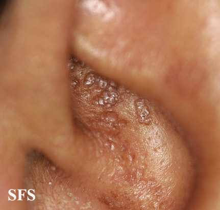 File:Amyloidosis (Dermatology Atlas 6).jpg