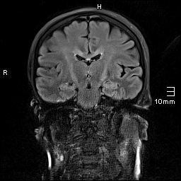 File:Amyotrophic lateral sclerosis (Radiopaedia 70821-81017 Coronal FLAIR 15).jpg
