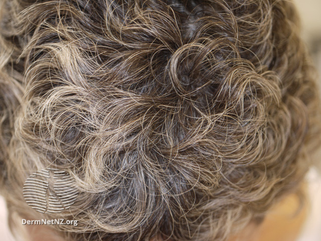 File:Anagen effluvium- regrowth after chemotherapy with curly hair (DermNet NZ hair-nails-sweat-anagen-effluvium-12).jpg
