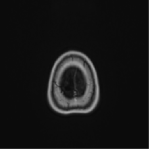 Anaplastic astroblastoma (Radiopaedia 55666-62194 Axial T1 C+ 73).png