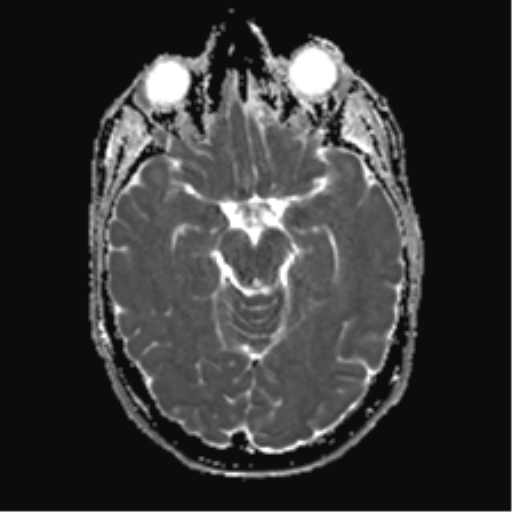 File:Anaplastic astrocytoma IDH mutant (Radiopaedia 50046-55341 Axial ADC 11).png